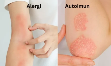 Reaksi Alergi Seseorang Akibat Sistem Kekebalan Tubuh