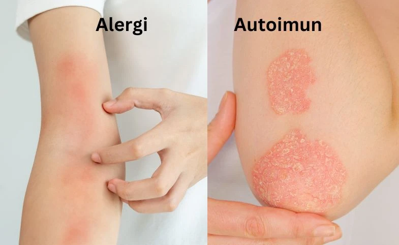 Reaksi Alergi Seseorang Akibat Sistem Kekebalan Tubuh