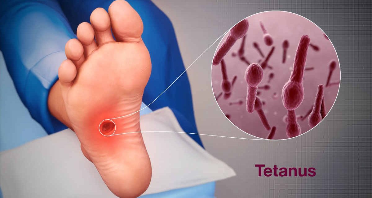 Penyakit Tetanus Merupakan Hal Serius Untuk Di Obati