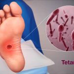 Penyakit Tetanus Merupakan Hal Serius Untuk Di Obati