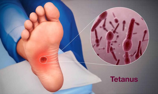 Penyakit Tetanus Merupakan Hal Serius Untuk Di Obati