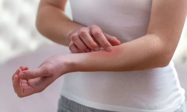 Reaksi Tubuh Terhadap Zat Tertentu Membuat Alergi