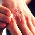 Penyakit Kulit Menular Terutama Pada Scabies Atau Kudis