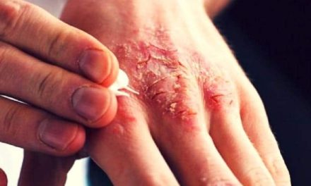 Penyakit Kulit Menular Terutama Pada Scabies Atau Kudis