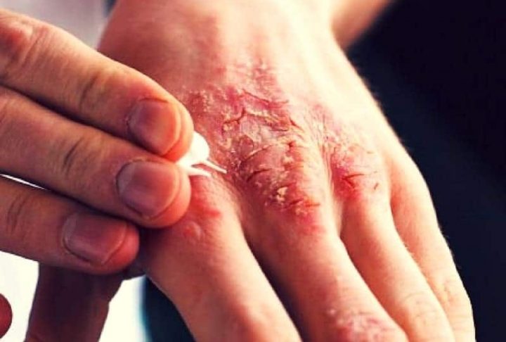 Penyakit Kulit Menular Terutama Pada Scabies Atau Kudis